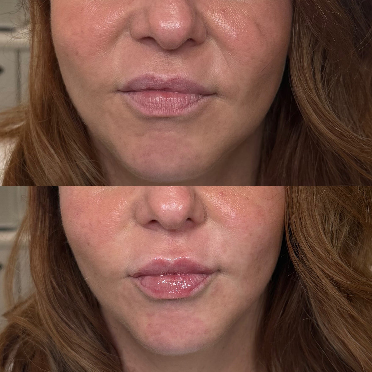 Signature Lip Enhancement
