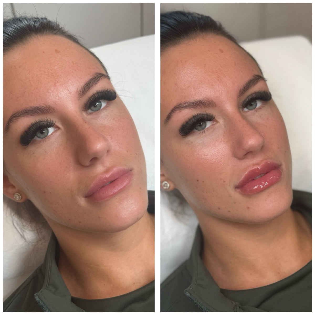 Signature Lip Enhancement