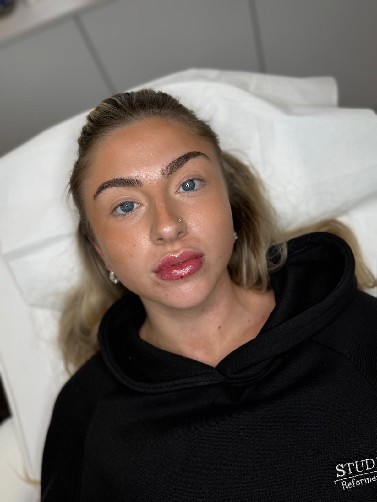 Signature Lip Enhancement