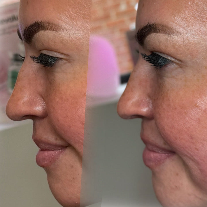 Liquid Rhinoplasty