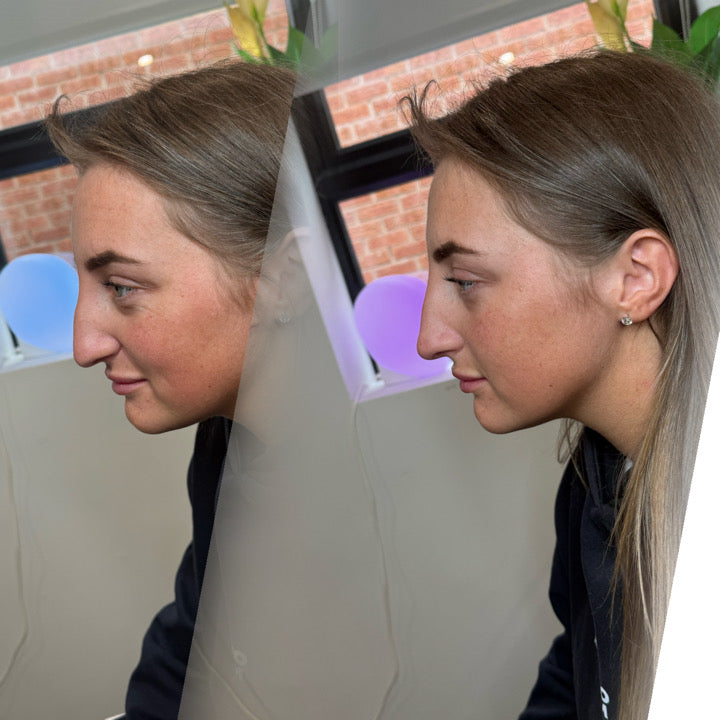 Liquid Rhinoplasty
