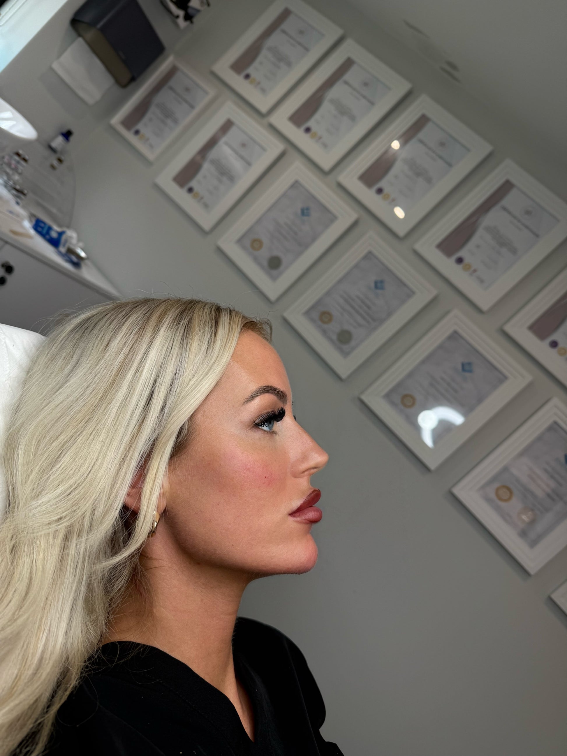 Facial Fillers